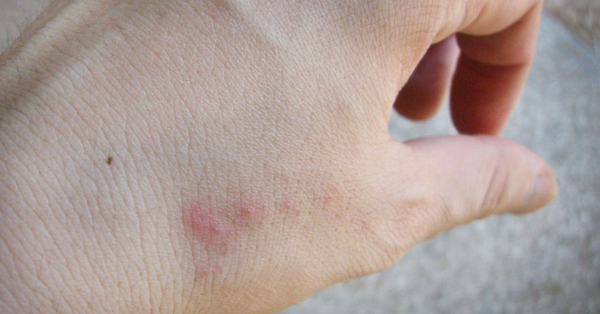 bedbugs bites bedbugs bites